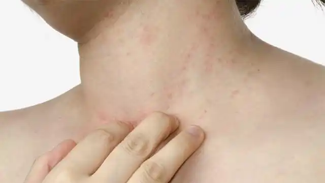 La dermatitis atópica empeora con el frío, alertan especialistas