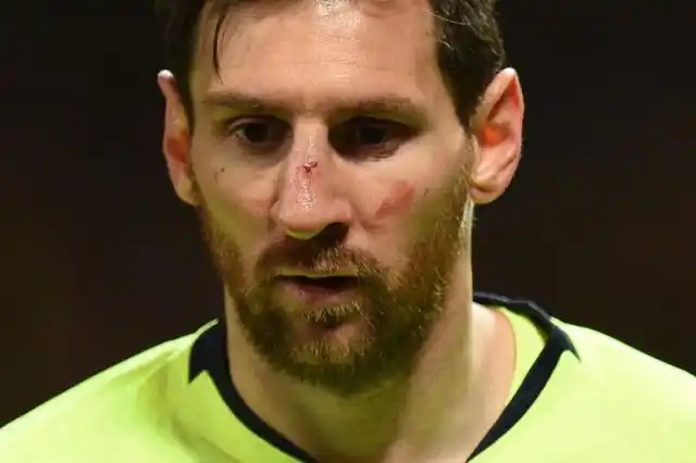 Solo un susto: Lionel Messi ya está recuperado del golpe en su nariz
