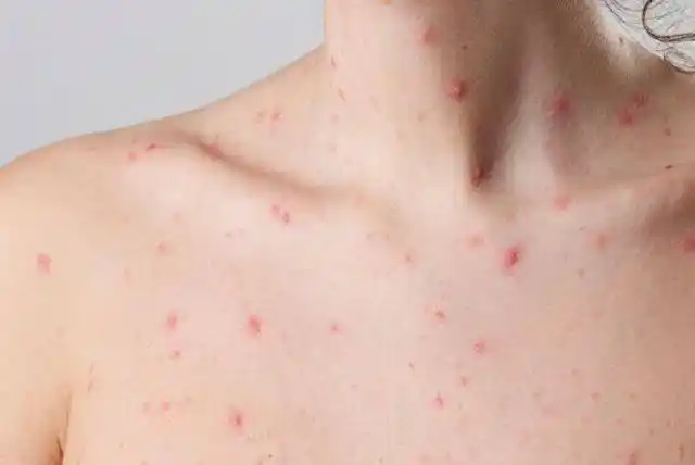 Uno de los casos se registró en la provincia de Santa Fe.