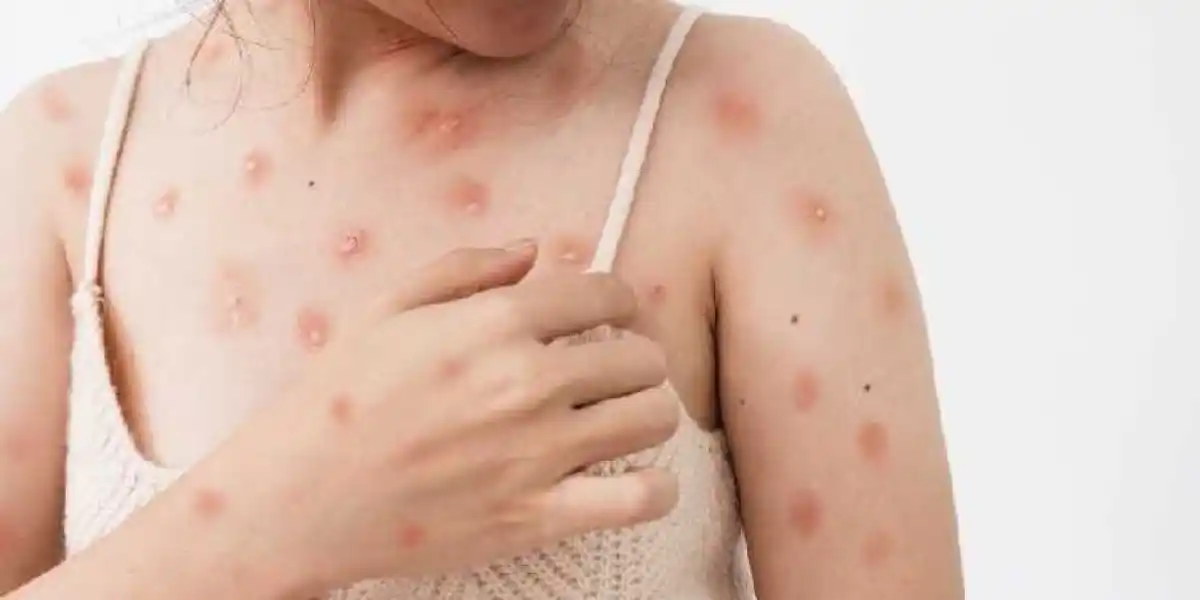 Viruela del mono: confirman dos nuevos casos en Córdoba y ya suman seis en la provincia