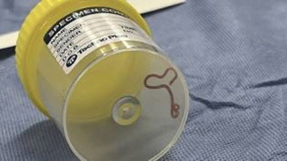 Retiran del cerebro de una mujer  en Australia, lombriz parasitaria que era común solo en canguros y pitones