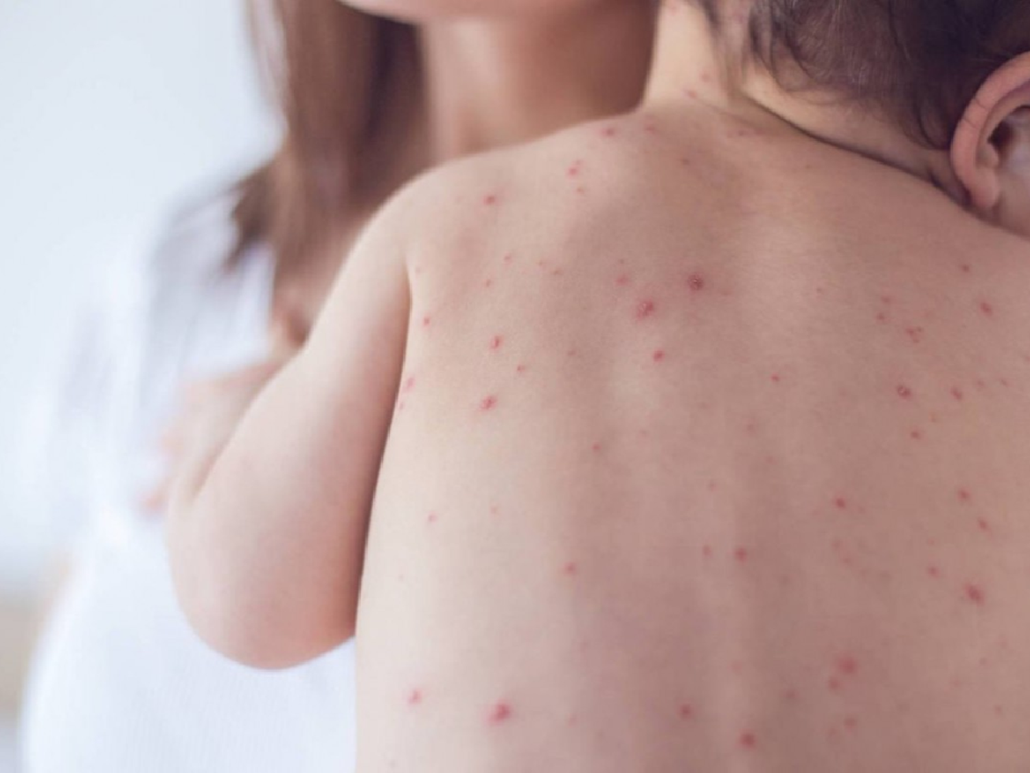 La mayoría de los casos de sarampión confirmados tienen nexo epidemiológico con personas no vacunadas