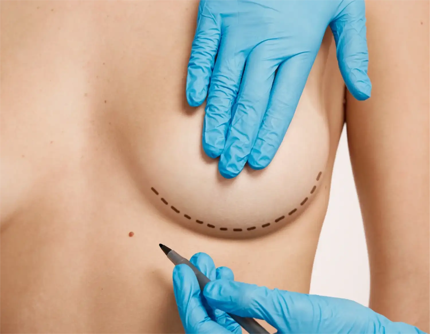 Todo lo que hay que saber sobre los implantes mamarios y sus posibles complicaciones