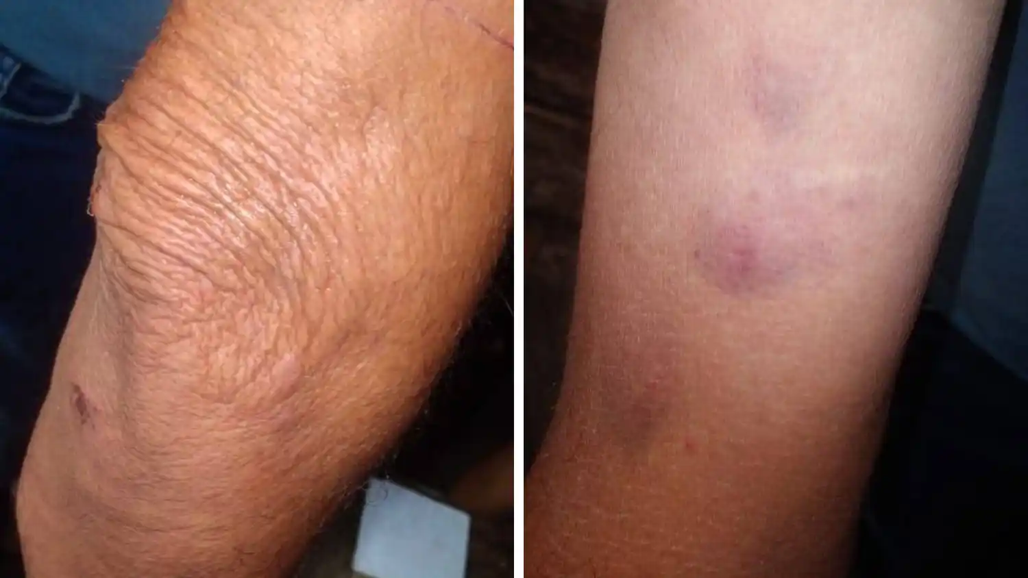 La hija de la víctima mostró una parte de las lesiones que le ocasionaron al jubilado.