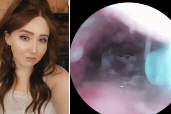 Le picaba el oído y encontró allí algo que nadie quisiera encontrar