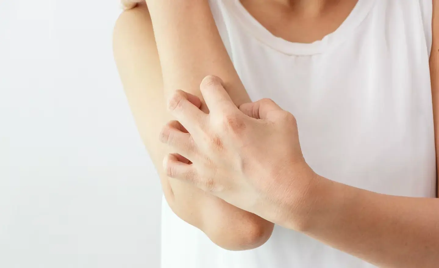 Urticaria por frío: el trastorno que provoca ronchas y puede desencadenar reacciones graves