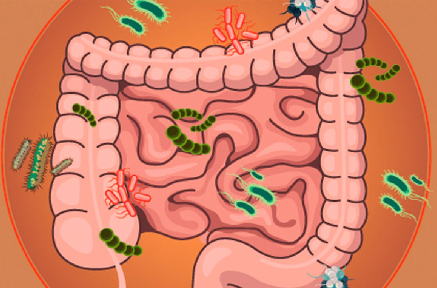 SIBO: Un desequilibrio intestinal que requiere atención nutricional