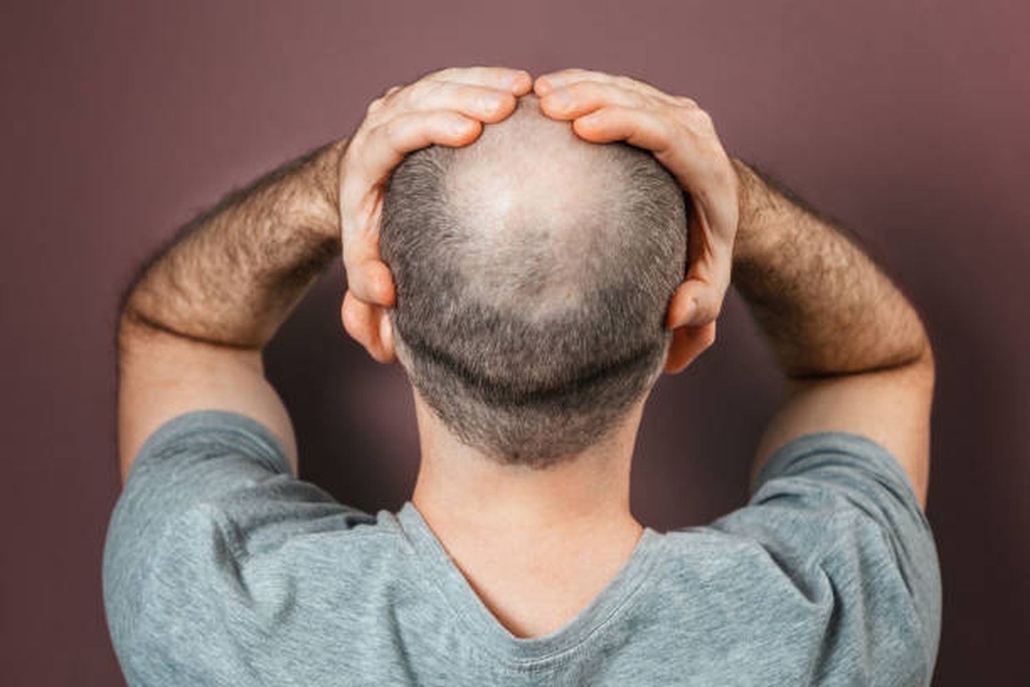 La caída del cabello es una problemática que afecta a millones de personas en todo el mundo.