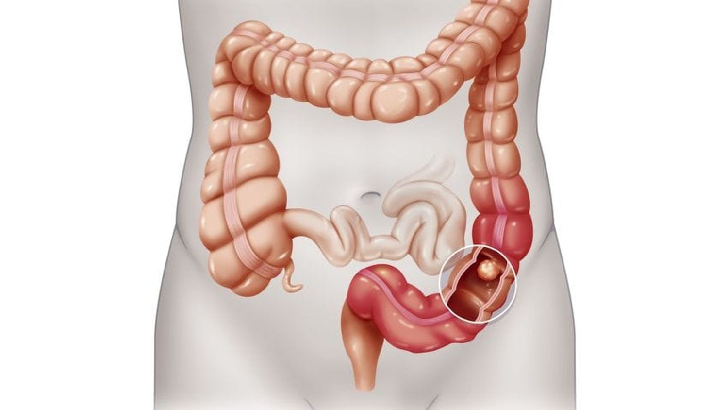 Colon Cancer Development