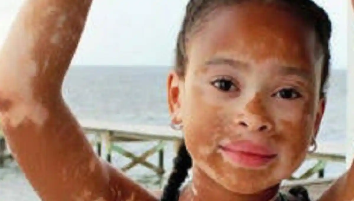 25 de junio: Día Mundial del Vitiligo