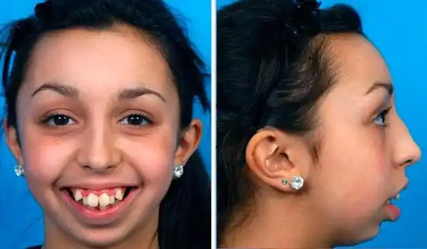 Video: el impresionante cambio de la chica que se operó 20 veces la boca 