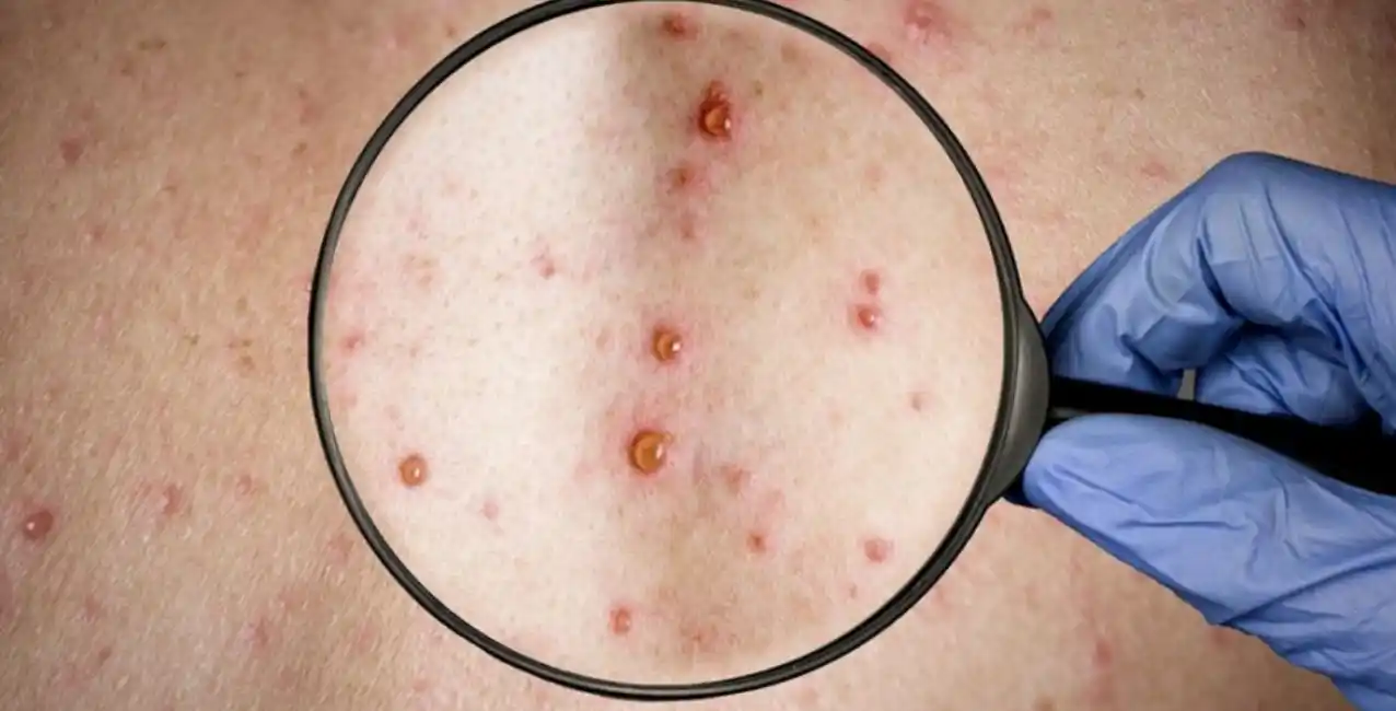 Confirman más de 5.000 casos de viruela del mono en el mundo