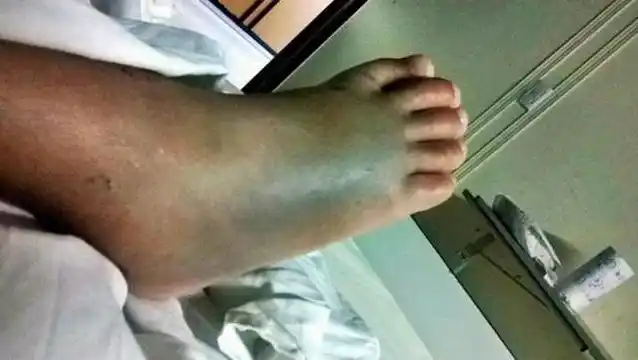 Así quedó el pie de un nene de 5 años que fue mordido por una yarará